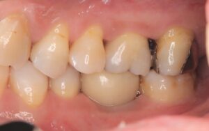 保険診療で治療された左上７番の銀歯（インレー）。マージン（つなぎ目）が全くあっていません。装着直後から虫歯になってしまいます。