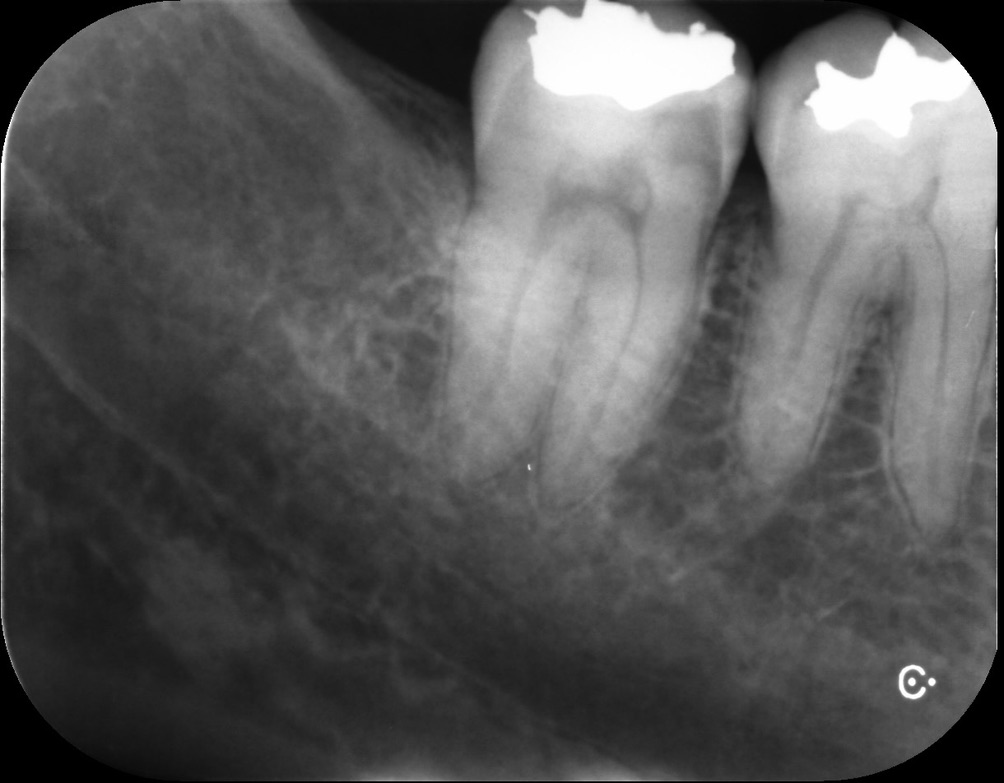 歯のヒビが原因で虫歯になった右側第二大臼歯