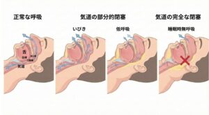 肥満による睡眠時の上気道閉塞の段階図(正常、いびき、低呼吸、無呼吸)と舌根沈下のメカニズム