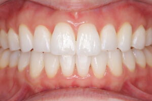 IMG_2240 - マウスピース矯正/ホワイトニング/美容歯科は銀座の歯医者|デンタルサロンナチュール銀座