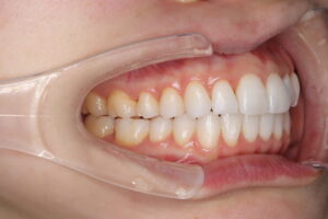 IMG_2247 - マウスピース矯正/ホワイトニング/美容歯科は銀座の歯医者|デンタルサロンナチュール銀座