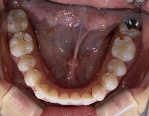 IMG_2973 - マウスピース矯正/ホワイトニング/美容歯科は銀座の歯医者|デンタルサロンナチュール銀座