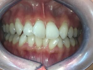 IMG_3317 - マウスピース矯正/ホワイトニング/美容歯科は銀座の歯医者|デンタルサロンナチュール銀座