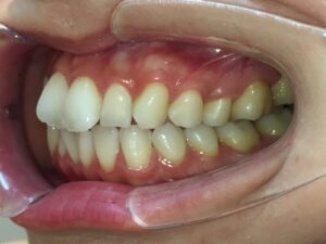 IMG_4873 - マウスピース矯正/ホワイトニング/美容歯科は銀座の歯医者|デンタルサロンナチュール銀座