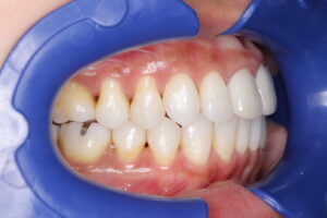 IMG_5347 - マウスピース矯正/ホワイトニング/美容歯科は銀座の歯医者|デンタルサロンナチュール銀座