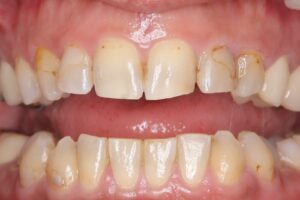 IMG_7459 - マウスピース矯正/ホワイトニング/美容歯科は銀座の歯医者|デンタルサロンナチュール銀座