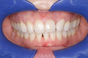 IMG_7543 - マウスピース矯正/ホワイトニング/美容歯科は銀座の歯医者|デンタルサロンナチュール銀座