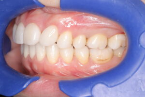 IMG_7547 - マウスピース矯正/ホワイトニング/美容歯科は銀座の歯医者|デンタルサロンナチュール銀座