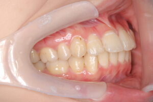 tc2 - マウスピース矯正/ホワイトニング/美容歯科は銀座の歯医者|デンタルサロンナチュール銀座