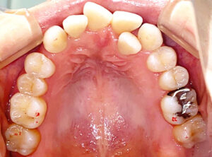 case04_a - マウスピース矯正/ホワイトニング/美容歯科は銀座の歯医者|デンタルサロンナチュール銀座