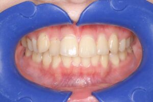 case07_a - マウスピース矯正/ホワイトニング/美容歯科は銀座の歯医者|デンタルサロンナチュール銀座