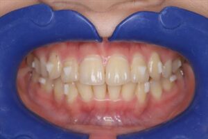 case08_a - マウスピース矯正/ホワイトニング/美容歯科は銀座の歯医者|デンタルサロンナチュール銀座