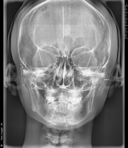 0609b2 - マウスピース矯正/ホワイトニング/美容歯科は銀座の歯医者|デンタルサロンナチュール銀座